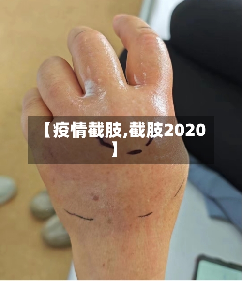 【疫情截肢,截肢2020】-第1张图片