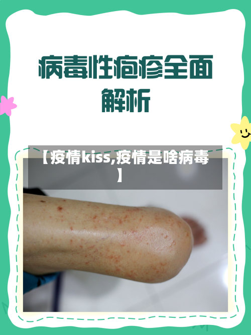 【疫情kiss,疫情是啥病毒】-第2张图片